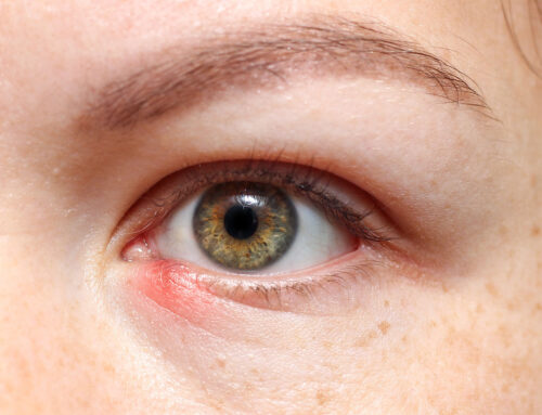 What’s A Stye And How Do I Avoid It